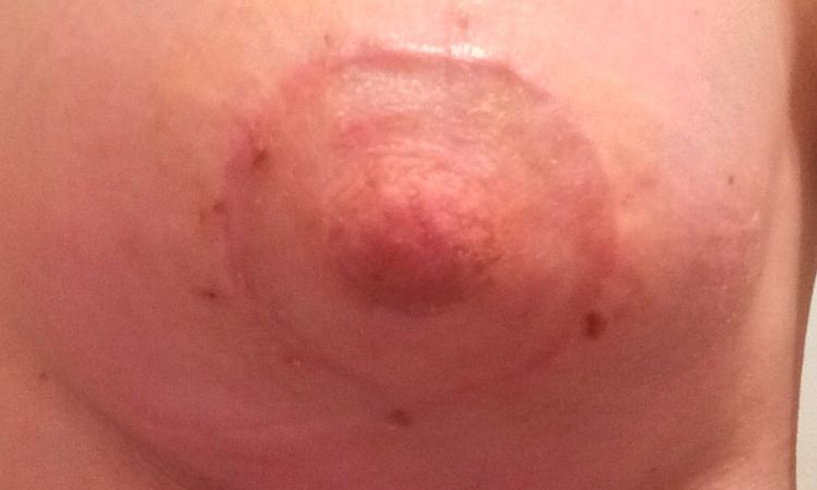 Evolución cicatriz areola - 7729