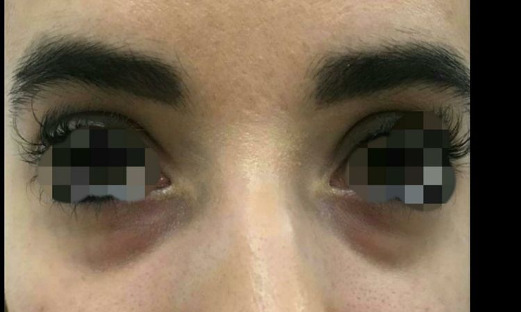 ¿Mis ojeras hereditarias tienen solución? - 7740