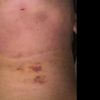 Depresión o hendidura después de lipo de papada