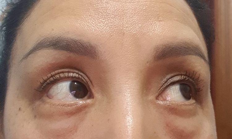 Blefaroplastia mal hecha bolsas inflamadas - 7840