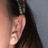 Granitos por delante de la oreja tras otoplastia - 7851