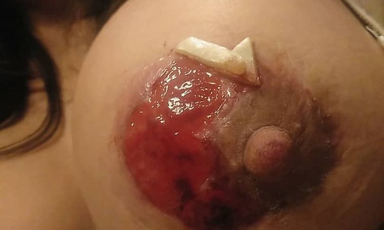 Herida abierta segunda intención mastopexia - 8046