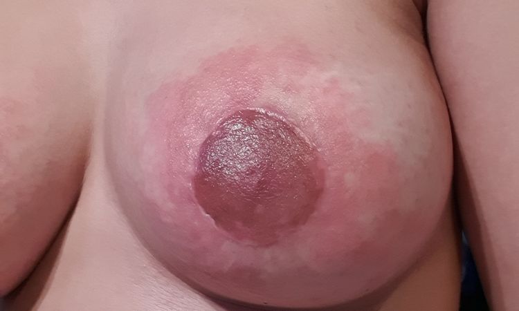 Prurito después de mastopexia con implantes - 8179
