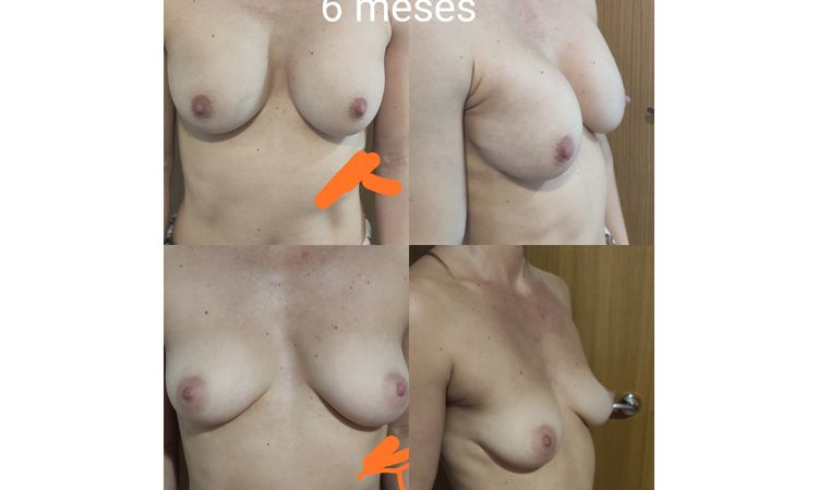 Aumento después de 6 meses 330cc anatómicas perfil alto - 8326