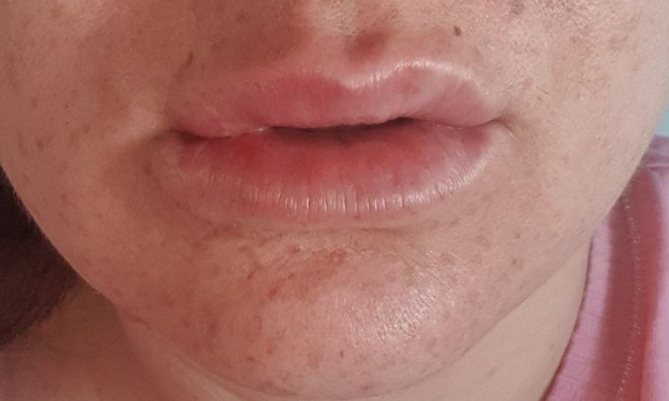 Labios duros después de relleno de labios com ácido hialurónico - 8354