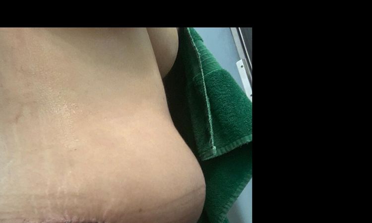 Bulto en el abdomen despues de una abdominoplastia - 8362