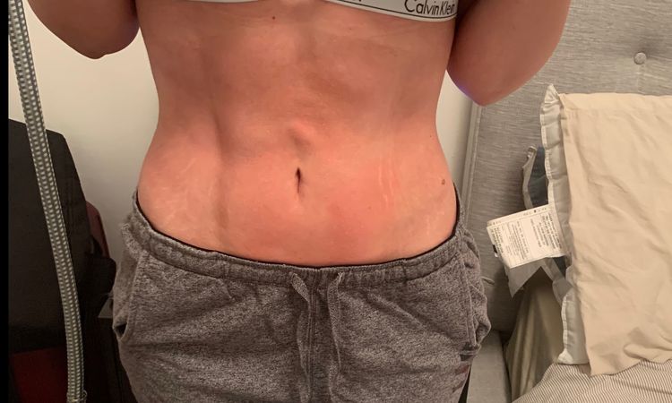 Una bola en mi abdomen después de una lipo marcasion! - 8377