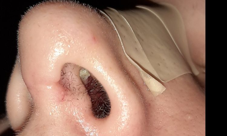 Se me ha soltado punto rinoplastia - 8406