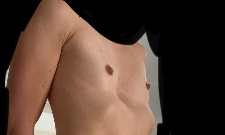 Tipo de protesis pectus excavatum - 8506