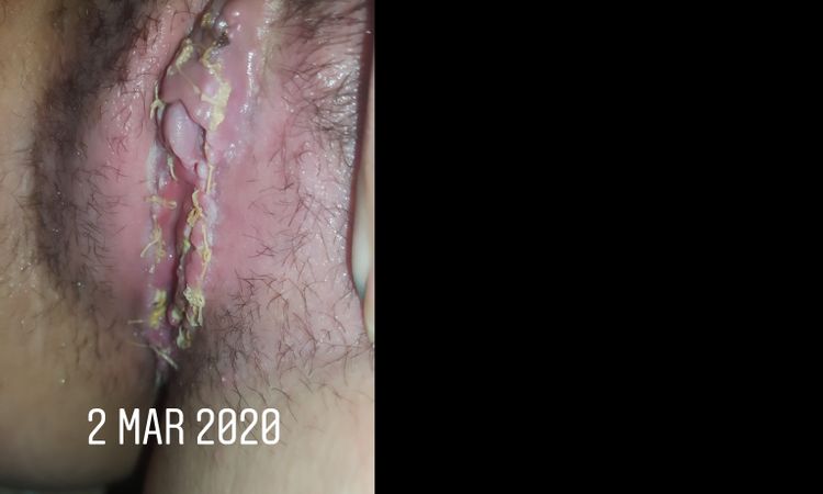 Puntos tras labioplastia - 8590