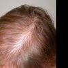 dosis finasteride alopecia androgénica de patrón femenino
