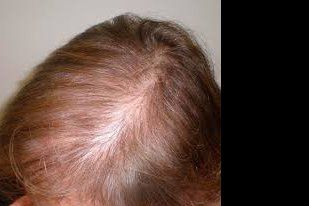 dosis finasteride alopecia androgénica de patrón femenino - 8653