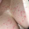 Granos y alergia en el pecho desde hace dos meses