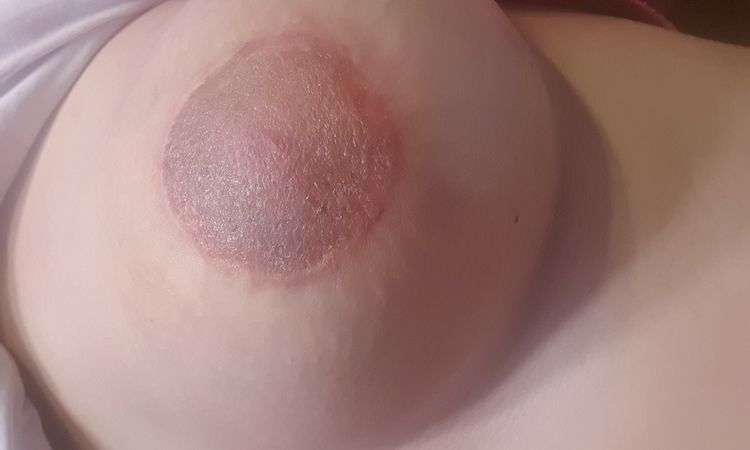 Picazón y sarpullido tras 6 meses de mastopexia periareolar - 8861
