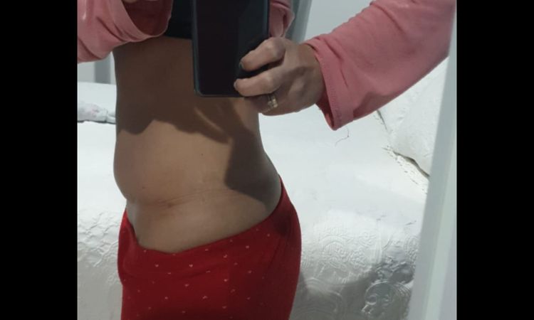 Retoque de cicatriz completa abdominoplastia - 12166