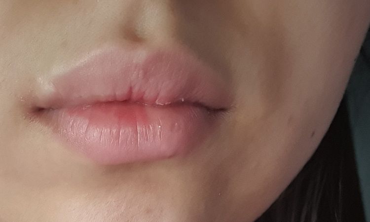 tratamiento para cicatriz deprimida en el labio superior - 12175