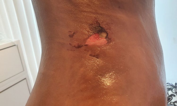 Quemadura por faja lipoescultura - 12224