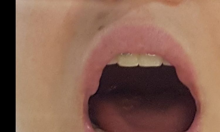 Bultitos por brackets tras poner acido hialuronico en labios - 12318