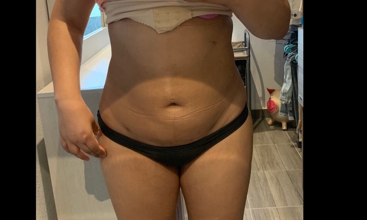 No veo resultados en mi lipoescultura - 12459