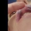 Hematomas o necrosis tras un aumento de labios con ácido hialurónico? - 12480