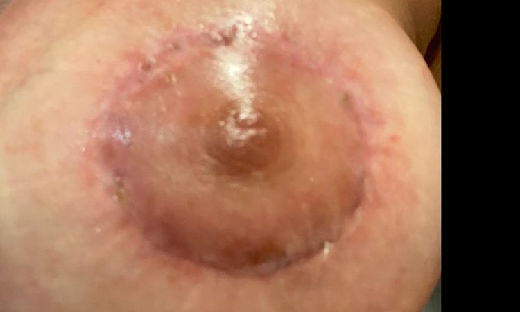 Rechazo de sutura en mastoplastia - 12514