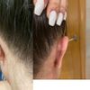 Bulto en cicatriz y diferencia orejas - 12576