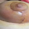 Pecho enrojecido y con dolor