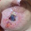 Úlceras en la piel del pecho por seroma ?