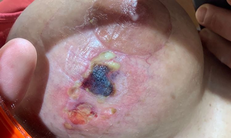 Úlceras en la piel del pecho por seroma ? - 15006