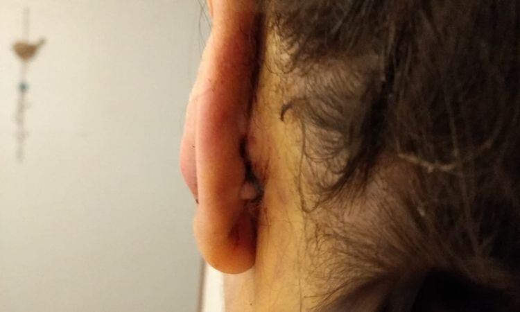 Bultos en la cicatriz otoplastia - 15035