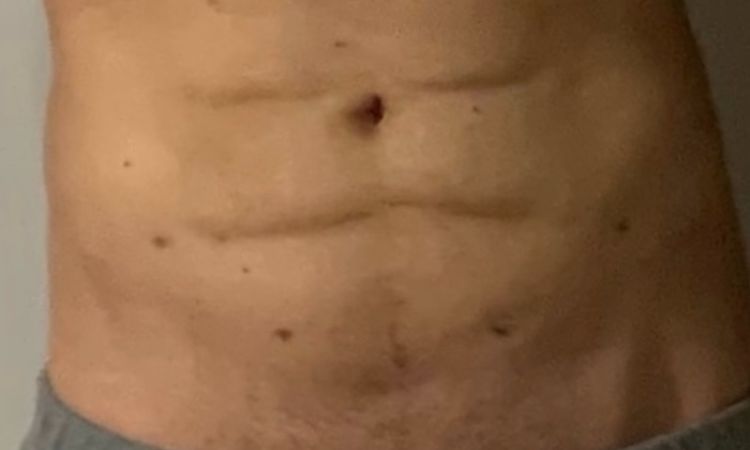 Surcos tras marcación abdominal - 15699
