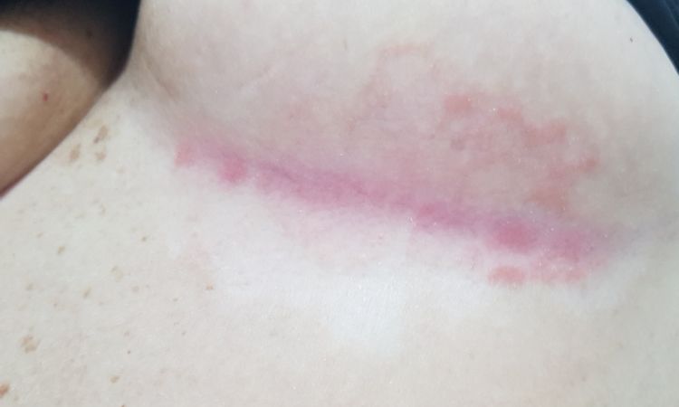 Mastopexia con psoriasis - 15705
