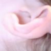 Bulto en la oreja tras una otoplastia