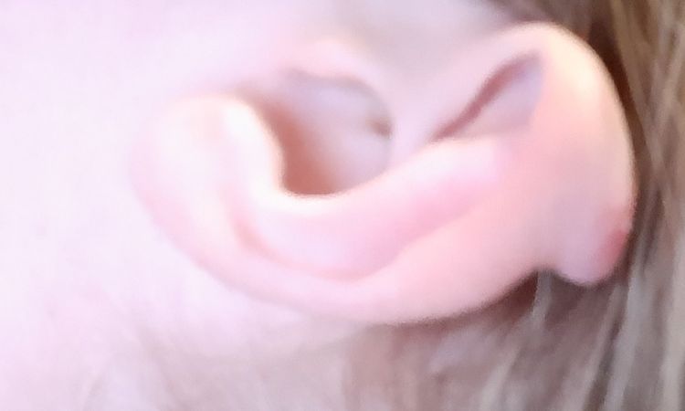 Bulto en la oreja tras una otoplastia - 15806