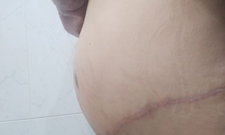 ¿Es normal seguir con diastasis después de abdominoplastia? - 15904