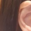 Cartilago de oreja aplastado, ¿se puede operar? - 15914
