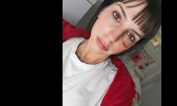 Blefaroplastia inferior ojo cerrado - 15981