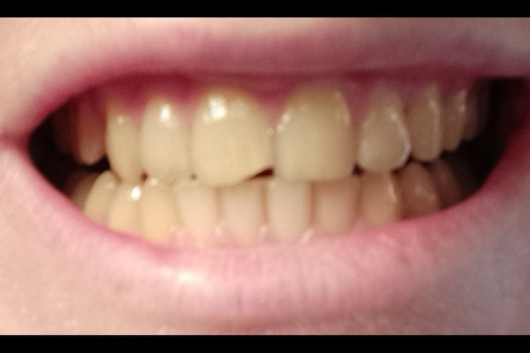 ¿Puedo hacerme un blanqueamiento dental con láser estando embarazada