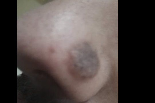 ¿Me recomendáis quitarme un lunar grande en la nariz? - 16370
