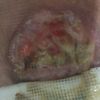Aoreola necrosis parcial y covid
