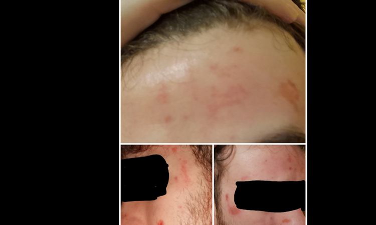 Sufro acne, que tratamiento debería hacerme - 16431