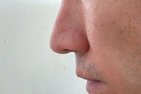 mal resultado rinoplastia en 2012 - 16473