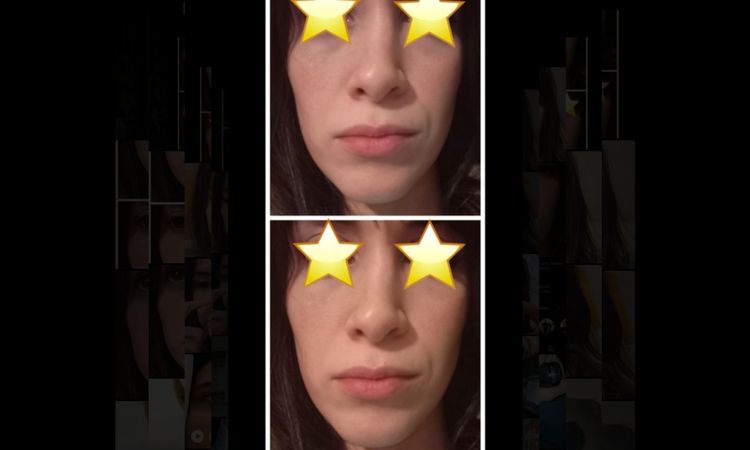 Rinoplastia y linea media labio-nariz. - 16624