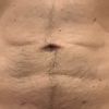 Flacidez tras liposucción abdominal HD