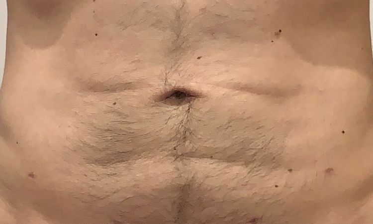 Flacidez tras liposucción abdominal HD - 16714