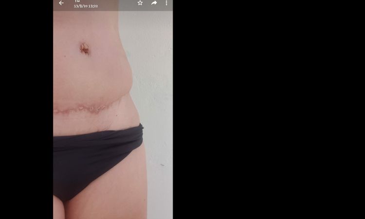 Bustos tras abdominoplastia - 16906