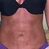 Aclarar la piel de mi abdomen después de una lipo y mini abdominoplastia - 33615