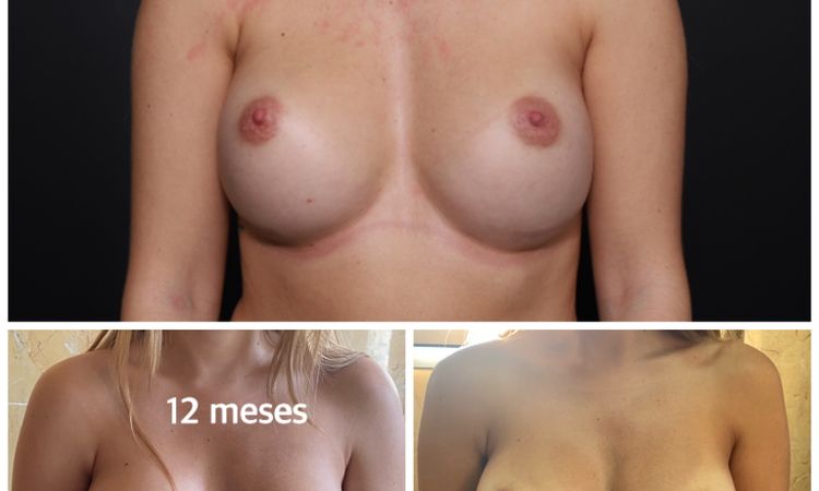 ¿Son normales los cambios que han tenido mis prótesis? - 41911