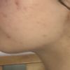 ¿Cirugía maxilofacial o simplemente implante de mentón?