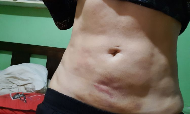 Fibrosis post lipo ayuda - 43675